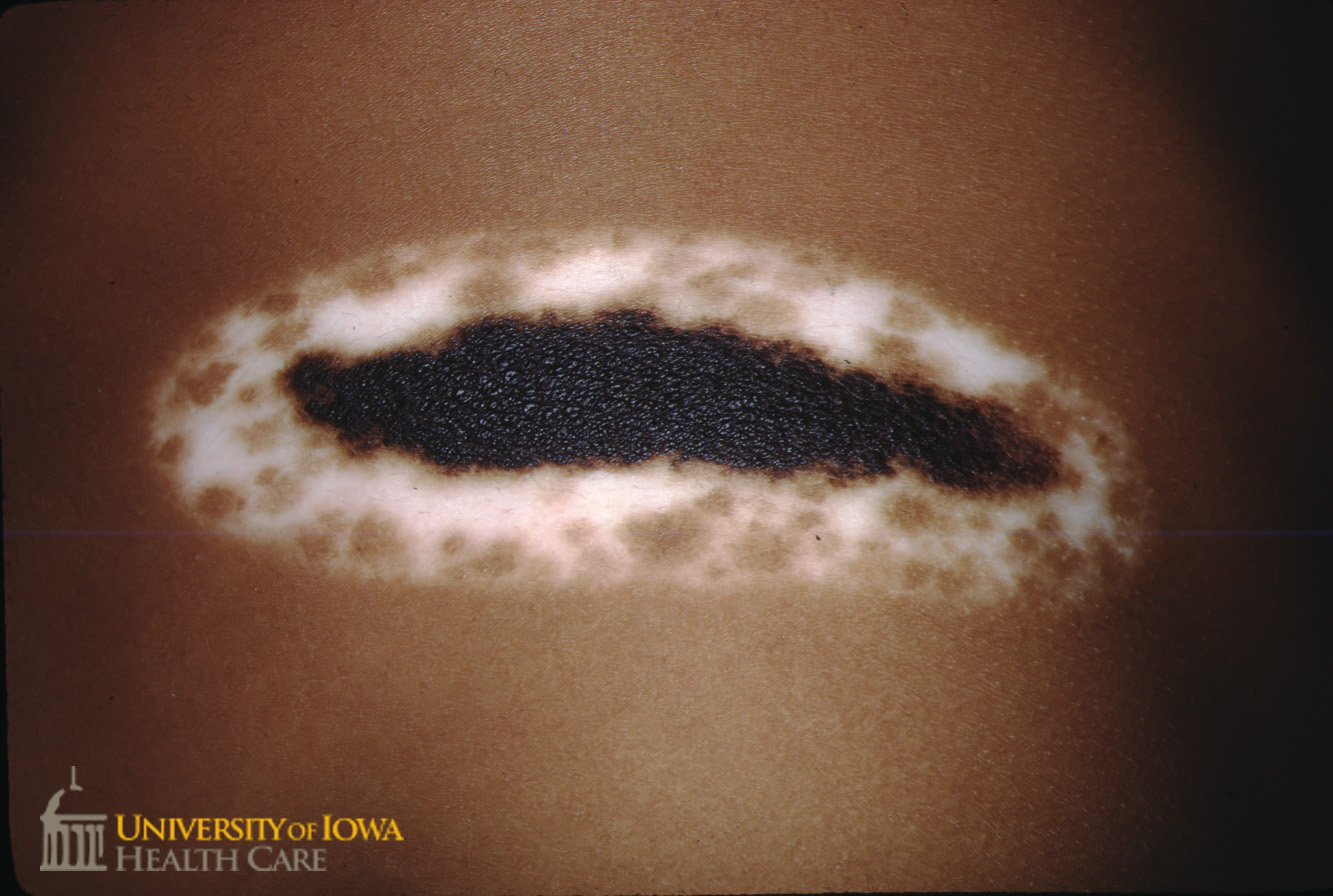 Variegated brown plaque with a surrounding depigmented patch with areas of retained pigment. (click images for higher resolution).
